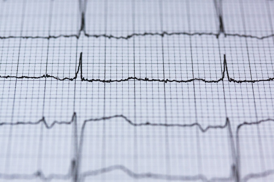 electro-cardiogram